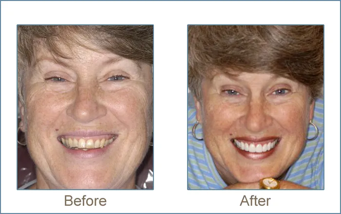 Before & after cosmetic dentistry