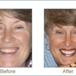 Before & after cosmetic dentistry