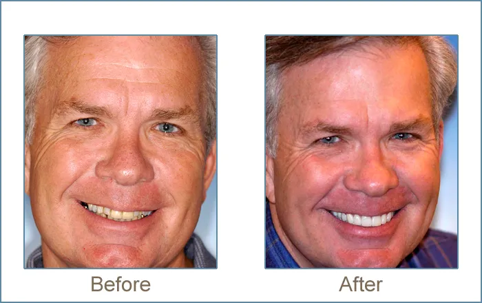 Before & after cosmetic dentistry