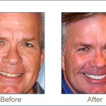 Before & after cosmetic dentistry