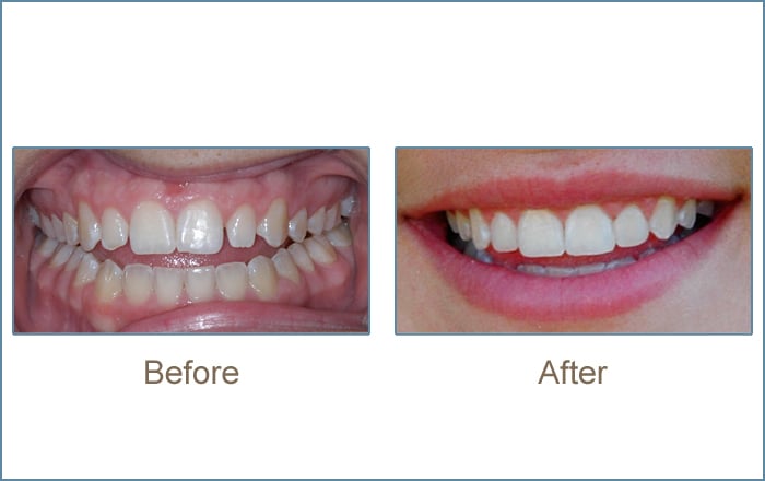 Before & after cosmetic dentistry