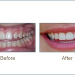 Before & after cosmetic dentistry