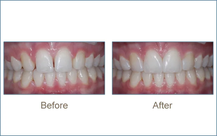 Before & after cosmetic dentistry