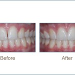 Before & after cosmetic dentistry
