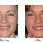 Before & after cosmetic dentistry