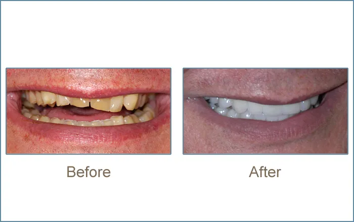Before & after cosmetic dentistry