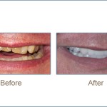 Before & after cosmetic dentistry