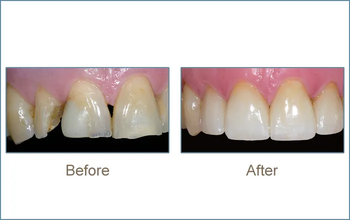 Before & after cosmetic dentistry