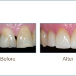 Before & after cosmetic dentistry