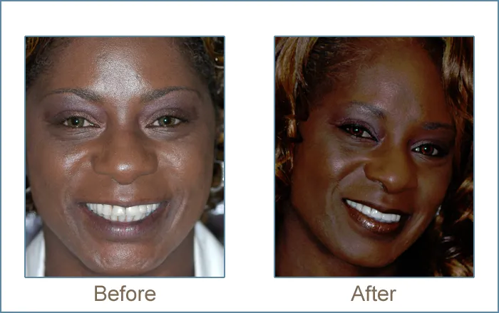 Before & after cosmetic dentistry