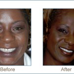 Before & after cosmetic dentistry