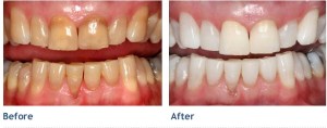 KöR Teeth Whitening - before and after photos