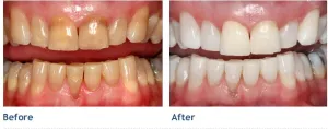 KöR Teeth Whitening - before and after photos